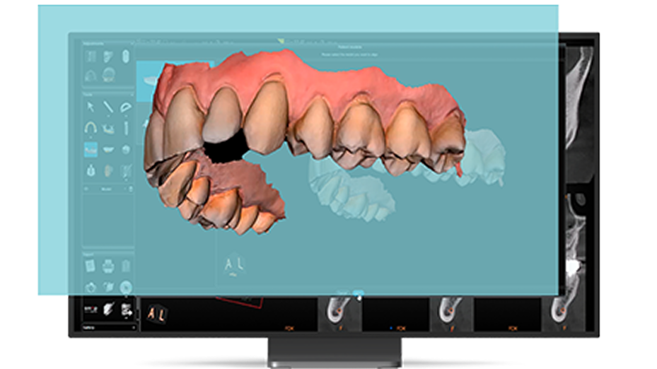 automatic-matching-of-cbct-and-intraoral-scans-for-prosthetic-dri automatic-matching-of-cbct-and-intraoral-scans-for-prosthetic-dri