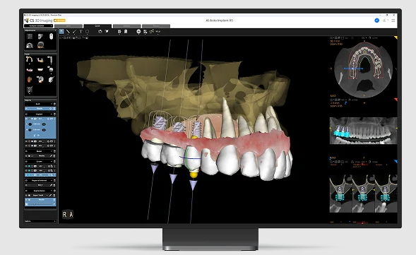 maxillary-implant-planning-with-ai-assisted-3d-cbct-imaging.webp maxillary-implant-planning-with-ai-assisted-3d-cbct-imaging.webp